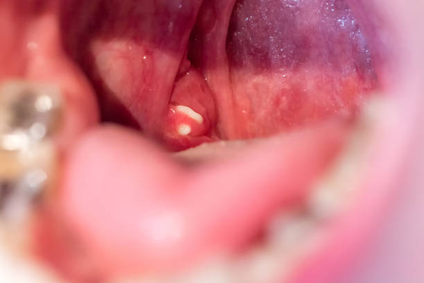 Can Tonsils Grow Back After Being Removed? - Tymoff